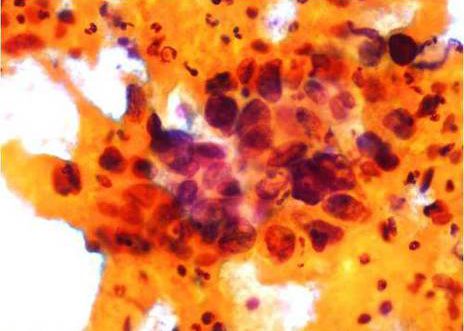 Carcinoma Escamoso. Celulas anormales xunto con celularidade inflamatoria.