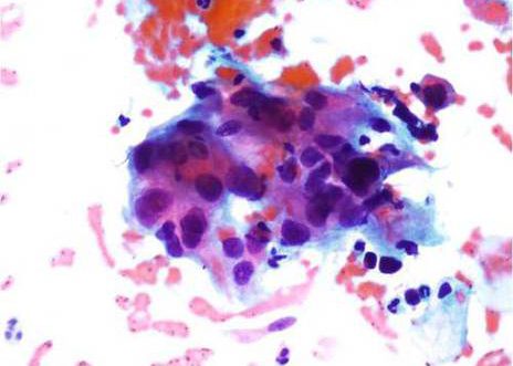 Squamous Carcinoma. Disproportionate enlargement of the nucleus, increased chromatin content and hyperchomasia.