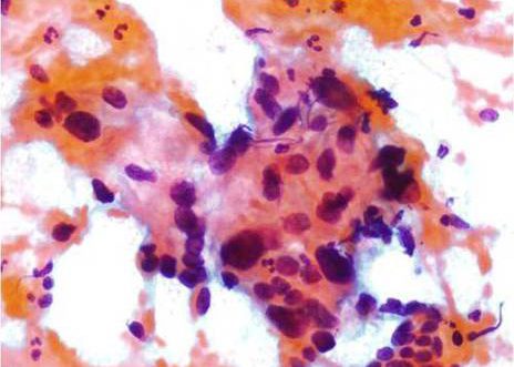 Squamous Carcinoma. These cells show disproporcionate enlargement of the nucleus, increased chromatin and hyprechomasia.