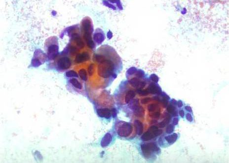 Endocervical Adenocarcinoma. Endocervical cell atypia. The cells show considerable variability of cell sizes.