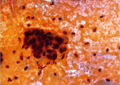 Poorly-differentiated endocervical adenocarcinoma. Cells with hypercromatic nuclei closely resemble poorly-differentiated malignant squamous cells.