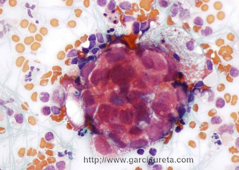 A rounded cluster. Most of the cells have eccentric nuclei touching periphery of the cells.