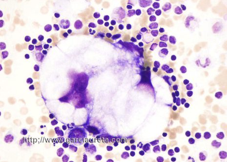 Several large vacuoles with sharp edges and pale staining are present.