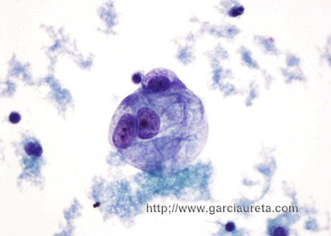 Malignant cells of variable size with prominent nucleoli and pale cytoplasm.
